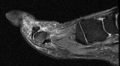 Figure 3 for case Plantar plate rupture